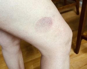 Cupping marks on leg